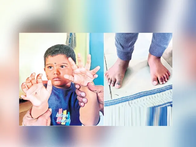 అరుదైన వింత.. నాలుగేళ్ల బాలుడికి 24 వేళ్లు