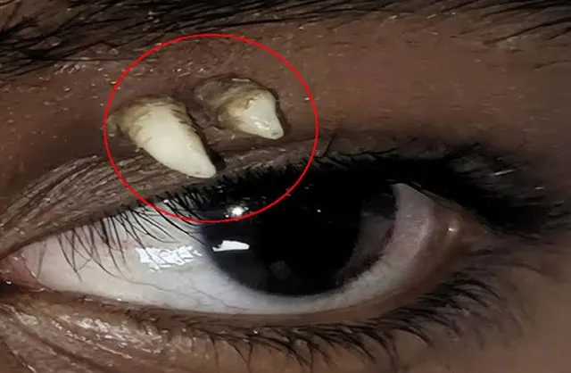 A rare case of a tooth growing in the eye that surprised doctors A rare case of a tooth growing in the eye that surprised doctors