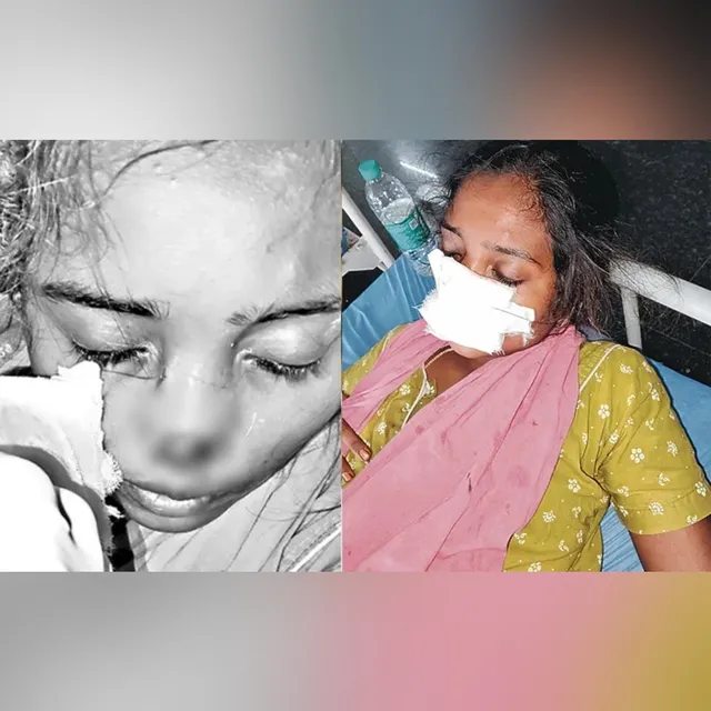 దారుణం.. కాపురానికి రావడం లేదని భార్య ముక్కు కొరికిన భర్త