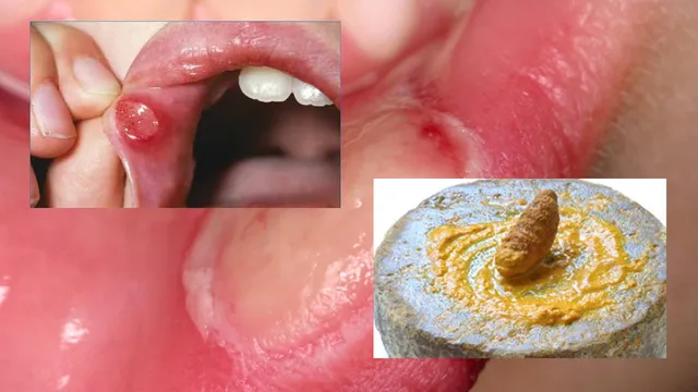 నోటి పూతకు ఇంటి చిట్కాలతో తక్షణ ఉపశమనం