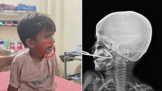 Iron rod stuck in mouth of five-year-old boy in Gujarat Iron rod stuck in mouth of five-year-old boy in Gujarat